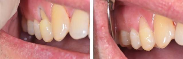 치경부마모증 레진 수복 치료 전후 사진 | 출처: 림플란트치과의원