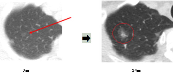 2002년 폐에서 7㎜ 크기의 간유리 음영 결절(빨간 화살표)이 발견된 환자의 저선량 흉부CT 영상과 11년이 지나 133개월 만에 14㎜ 배로 커진 결절의 모습(오른쪽 빨간 원 안). 삼성서울병원 제공
