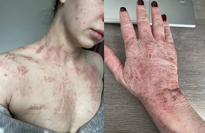 레베카는 만약 다시 스테로이드를 사용한다면 의존성이 더 심해질 것으로 판단하고, 다시 사용하지 않기로 결정했다. [사진=영국 일간 더선 보도 갈무리]