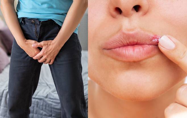 현재 전세계적으로 8억 4600만 명 이상의 성인이 생식기 헤르페스에 감염되어 있을 것으로 추정된다는 연구 결과가 나왔다. [사진=게티이미지뱅크]