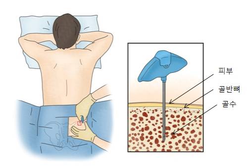 골수 검사 방법. /그림=서울아산병원