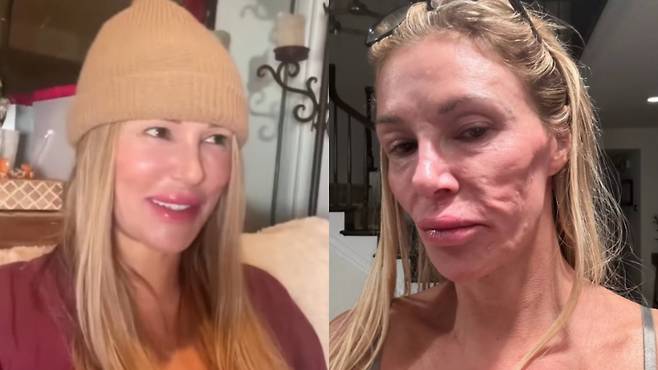 미국의 리얼리티 스타 브랜디 글랜빌(52)이 자신의 심각한 피부 상태를 공개하며 "원인을 찾고 있다"고 했다. /글랜빌 인스타그램