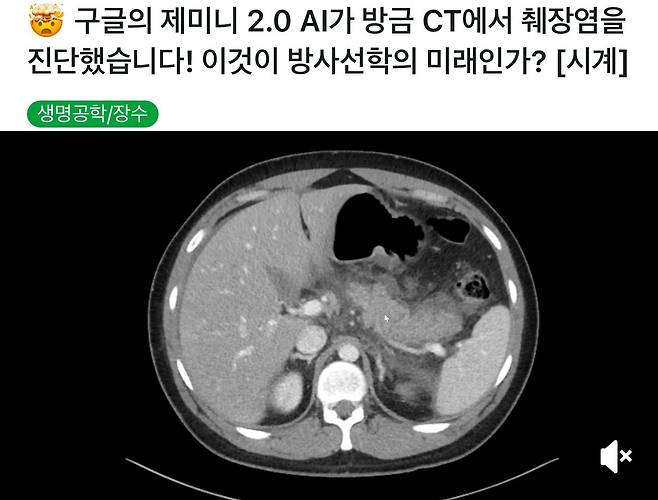 IMG_1356.jpeg 구글Ai 잼민이 CT로 체장염 진단성공 ㅎㄷㄷㄷ