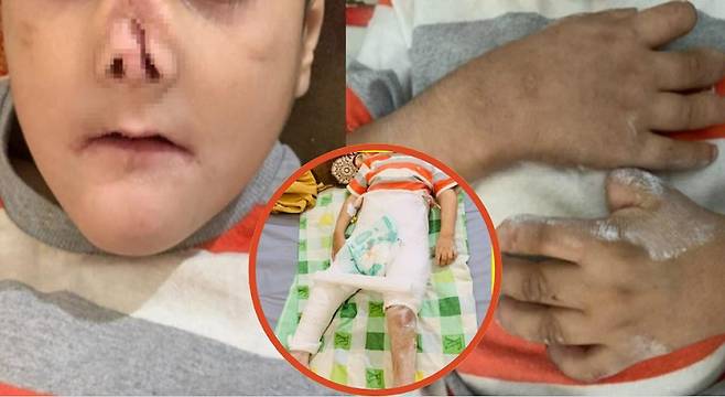 선천성 통증 무감각증(CIPA)으로 뼈가 부러져도 통증을 느끼지 못하는 5세 소년의 사연이 공개됐다. 통증이 없기 때문에 자해를 일삼아 코, 손 등 전신에 상처가 있는 모습./사진=임상사례보고저널