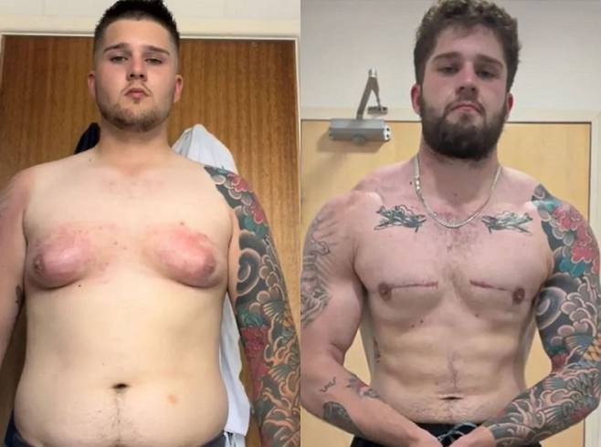 영국의 한 20대 남성이 C컵 크기의 가슴에 자신감을 잃고 살았다가 여성형 유방증을 진단받고 절제술을 받은 사연이 공개됐다./사진=더 선