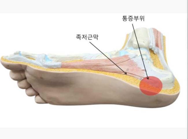 족저근막염은 말 그대로 ‘발바닥 아치를 지탱하고 있는 근막에 염증이 생기는 질환’이다. / 셔터스톡스