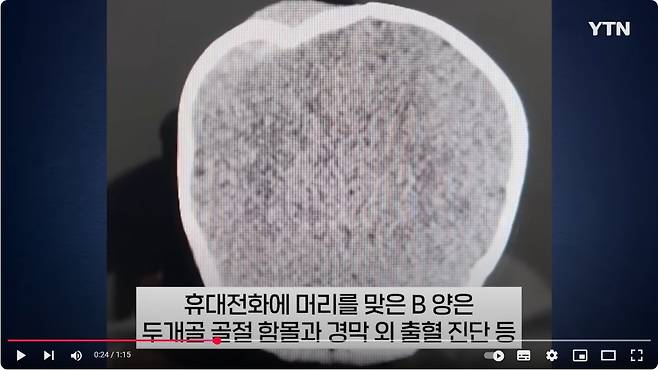 10개월 4.JPG 시내버스에서 생후 10개월된 아기에게 핸드폰 던져 중상 입힌 20대 여성