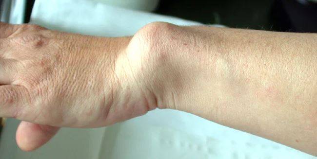 레리-웨일 증후군 환자들은 손목에 마데렁 변형(Madelung’s deformity)이 나타나기도 한다./사진=Samarpan Physiotherapy Clinic