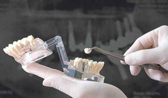 임플란트 모형. 중앙포토