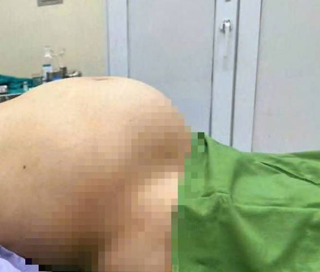 거대하게 자란 난소 난종으로 임신 8개월 차처럼 배가 부풀어 오른 베트남 50대 여성 복부 모습/사진=자딘 닷 베트남