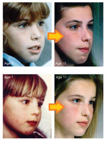 구강 호흡을 하던 자매의 얼굴 변화. 두 자매는 모두 어릴 때 구강호흡을 했지만 샘(위)은 교정하지 않았고, 켈리(아래)는 코로 숨을 쉬려고 의식적으로 노력했다. 그 결과, 샘만 아데노이드형 얼굴 증상이 나타났다./사진=책 'Reading the face' p.90