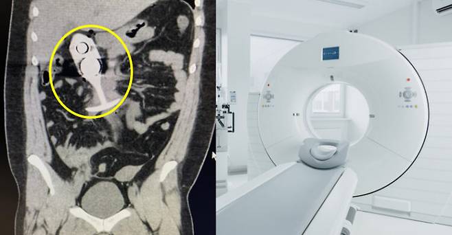MRI 촬영 중 몸속에 있던 성인용품 속 금속이 자기장에 반응해 고통을 호소한 20대 여성 환자의 사연이 소개됐다. [왼쪽 사진='데일리메일' 보도내용 캡처/오른쪽 사진=게티이미지뱅크]