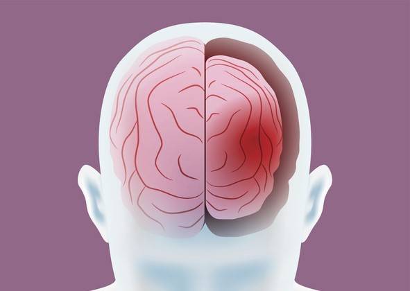 마취제로 쓰는 제논가스가 알츠하이머병 예방을 돕는 것으로 나타났다. 게티이미지뱅크 제공.