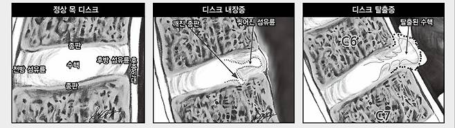 목디스크 구조. 도서출판 언탱글링 제공