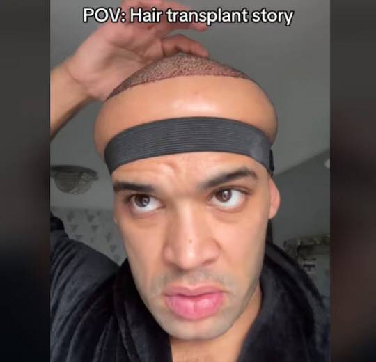 모발 이식 수술을 받은 카나 플렉스. 틱톡 캡처