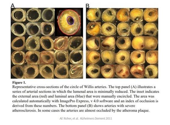 * 사진 출처: AE Roher, et al. Alzheimers Dement 2011