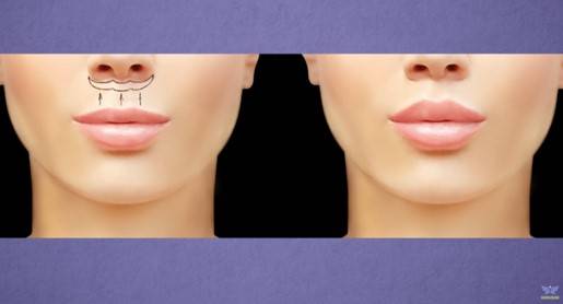 인중 축소술(lip lift). [사진='Doctor Youn' 유튜브 채널]