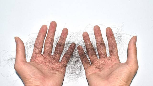 탈모의 종류로는 남성형 탈모, 원형 탈모, 휴지기 탈모, 외상성 탈모, 화학적 탈모 등이 있다｜출처: 클립아트코리아