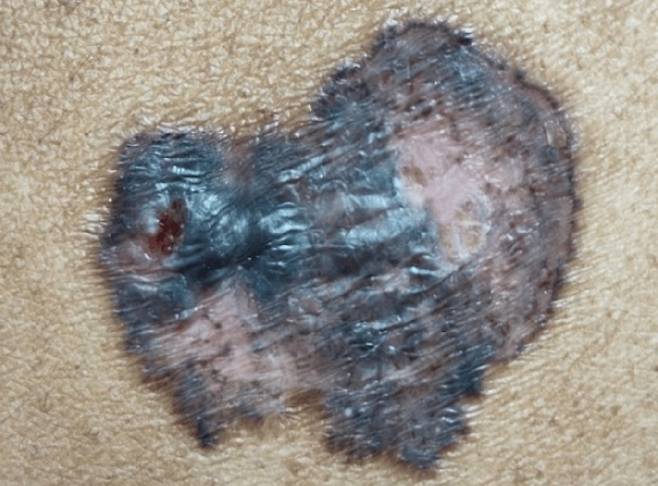 68세 여성 엉덩이에서 20년째 지속되던 까만 병변이 피부암인 것으로 뒤늦게 확인됐다./사진=큐레우스 저널