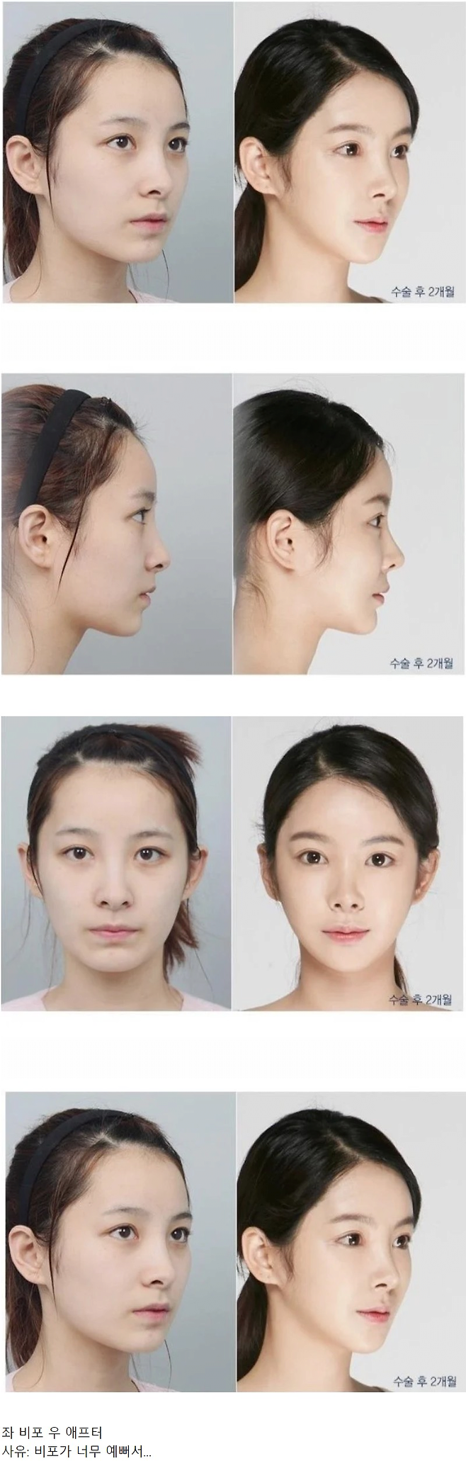 image.png 사람들이 너무 안타까워한 성형외과 비포애프터 사진.jpg