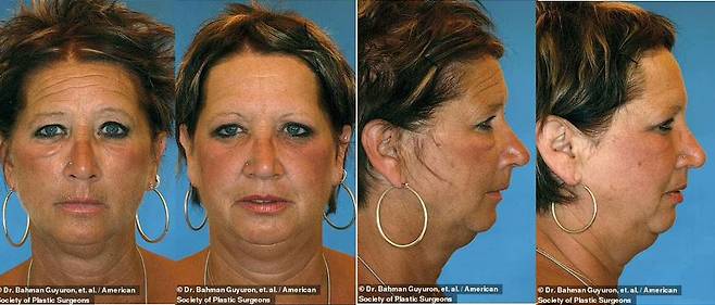 20년간 흡연한 브렌다(왼쪽)와 비흡연자 바브(오른쪽)./사진=American Society of Plastic Surgeons