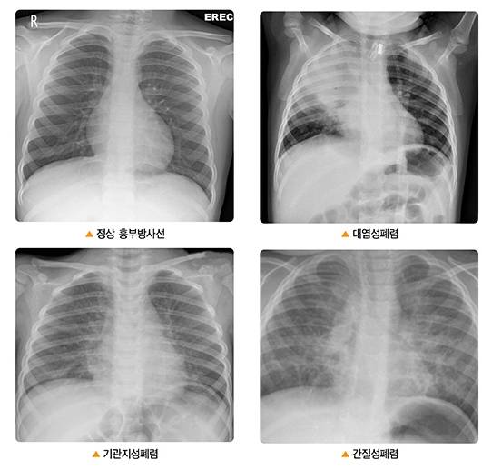 흉부 방사선 촬영 검사 소견에 따른 폐렴 유형별 병변. /사진=질병관리청