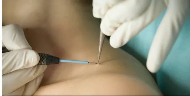 40, 50대에 많이 생기는 쥐젖을 집에서 제거하려다 흉터나 화상 등 후유증을 많이 겪는다. 사진은 병원에서 쥐젖은 떼어내는 모습. [USA Today 홈페이지 캡쳐]