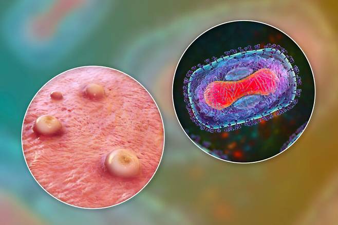 천연두에 걸리면 고열, 심한 발진, 진물이 나는 농포가 생기고 약 3분의 1은 사망하게 된다. [사진=클립아트코리아]
