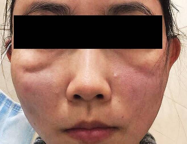 얼굴 실 리프팅 시술 후 피부 함몰이 생긴 사례./사진=​'성형 및 재건 외과 글로벌​' 저널