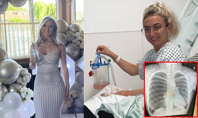 네 번이나 기흉을 겪은 여성이 자신의 경험을 공유했다. 그는 흡연도 하지 않았고 건강에 별다른 문제도 없었다. [사진='니드투노우' ]