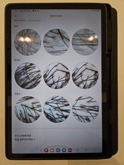 AI 업체 '리필드'가 자체 개발한 두피 스캐너로 이마, 정수리, 뒤통수 사진을 찍은 화면. (사진=박재현 기자)