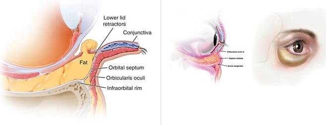 예전에 주로 시행되었던 눈밑지방제거(왼쪽). 지방이 많아서가 아니라, 지방을 지지하는 구조가 약해져 눈밑 지방이 불룩하게 돌출된 모습을 확인할 수 있다(오른쪽). [사진=Master Techniques in Facial Rejuvenation, Elsevier(왼쪽) / Aesthetic Surg J 2005;25:628]