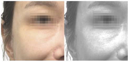 기존 재배치된 지방 아래로 또 다른 고랑이 보이기 시작한다.