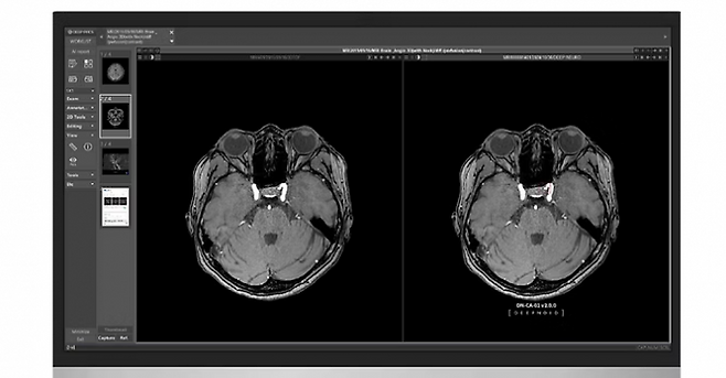 딥노이드의 뇌동맥류 진단 솔루션 '딥뉴로' 구동 화면. 딥노이드 제공