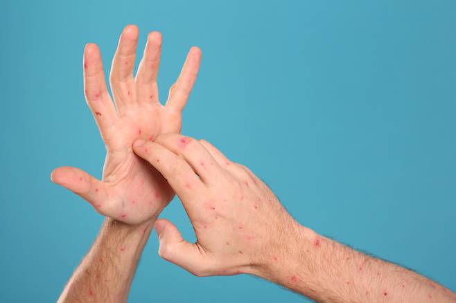 지난해 연간 매독 환자는 2786명으로 10년 전인 2014년의 1015명보다 2.7배 늘어났다. [사진=게티이미지뱅크]