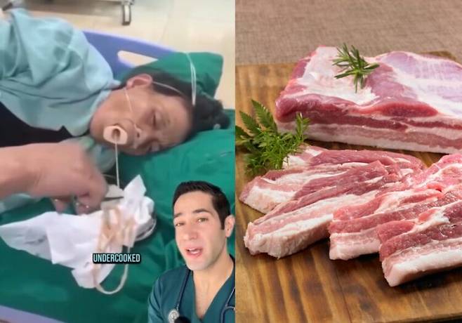 한 의사가 여성의 입에서 끊임없이 이어져 나오는 촌충의 영상을 공개하며 덜 익힌 고기를 먹으면 어떤 끔찍한 결과를 초래할 수 있는지 경고했다. [사진= 외신 갈무리(왼쪽), 게티이미지뱅크]