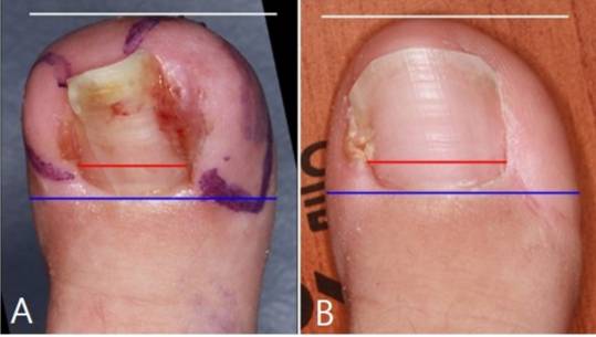 내성발톱 환자의 연부조직 절제술 전후 비교 사진. 수술 전(A) 발톱 폭이 좁았지만, 연부조직 절제술 후(B) 발톱 폭 비율이 최대 52.52% 더 개선됐다. /사진=세브란스병원