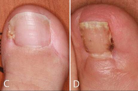 (C)연부조직 절제술을 받은 발톱&nbsp;(D)발톱 절제술을 받은 발톱의 모습. 연부조직 절제술을 받은 발톱이 발톱 절제술을 받은 사례와 비교해 회복 후 발톱의 폭이 크게 개선되는 모습을 보였다.