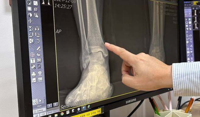 정비오 교수는 "발목 관절염 환자는 엑스레이 상 뼈와 뼈 사이의 공간이 좁거나 없다"고 말했다./사진=경희대병원 제공