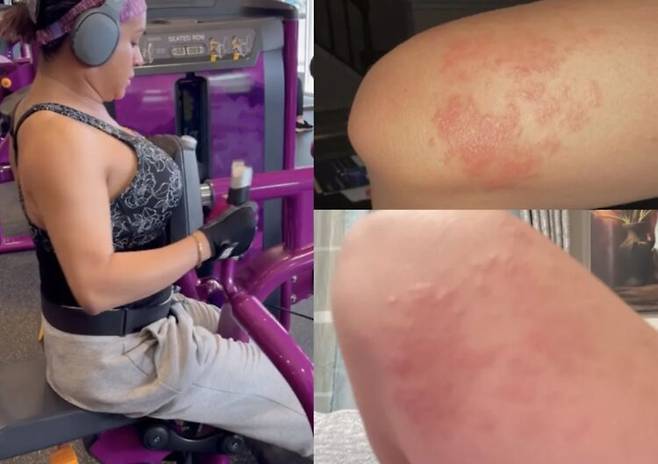한 여성이 운동을 마친 후 가려운 증상을 겪고 모기 물린 줄 알았으나, 심각한 백선 감염인 것으로 드러나 헬스장을 이용하는 사람들에게 주의를 당부했다. [사진=영국 일간 더선 보도 갈무리]