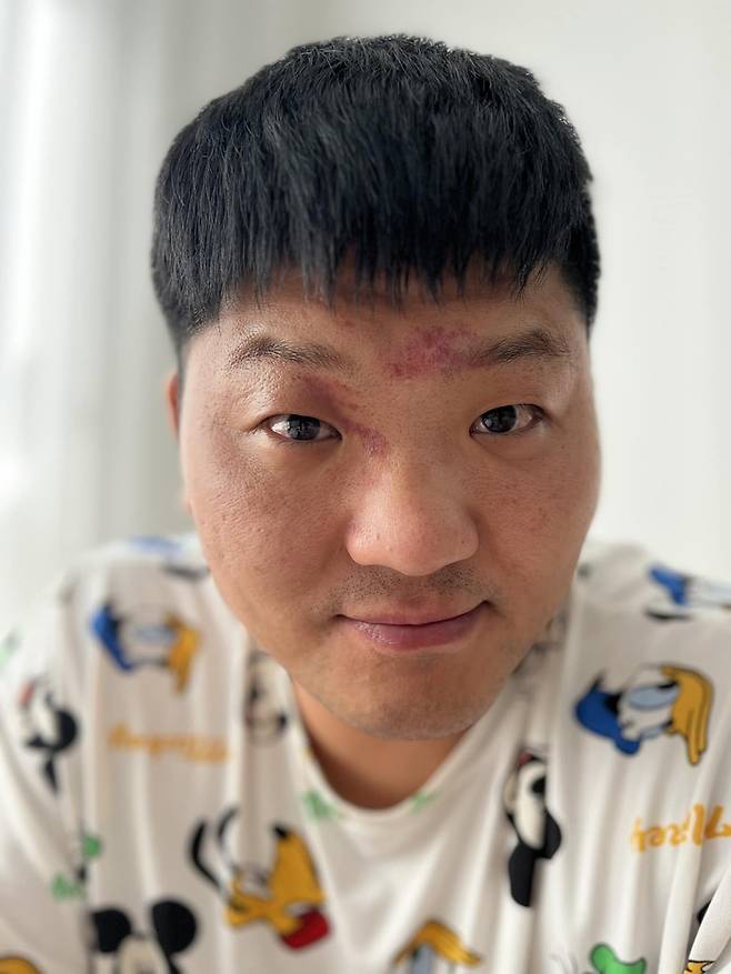 상처 투성이인 권아솔의 얼굴. 사진 | 권아솔 SNS