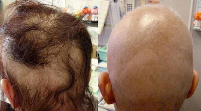 외국의 한 40대 여성이 염색을 한 후 탈모를 겪은 사례가 보고됐다. 왼쪽은 염색약 사용 후 6일 뒤, 오른쪽은 2개월 뒤 모습이다./사진=미국 국립보건원