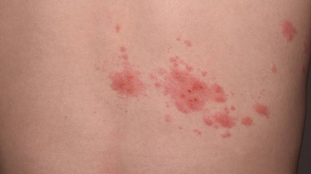 대상포진은 수두-대상포진 바이러스(varicella-zoster virus, VZV)가 원인인 질환이다｜출처: 클립아트코리아