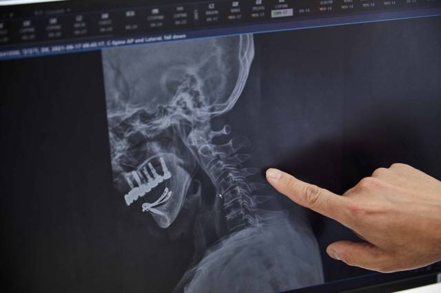 거북목 환자의 목뼈./사진=신지호 기자