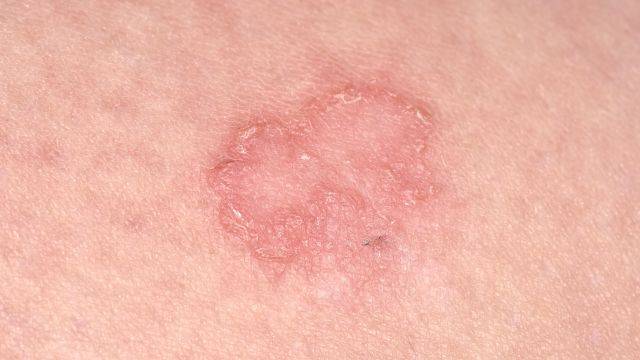 백선의 주요 증상 중 하나는 붉은 발진이다 ｜출처: 클립아트코리아