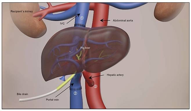 유전자 조작 미니 돼지 간 이식 수술 개요 그림 ①하대정맥 ②간문맥 ③간동맥 [Nature / Lin Wang et al. 제공. 재판매 및 DB 금지]