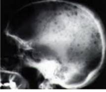 다발골수종 병변. /사진=서울아산병원