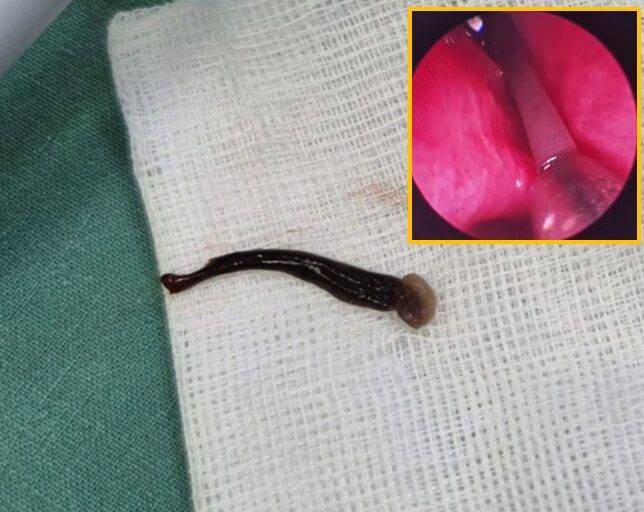 나흘 동안 수시로 코피가 나던 세 살 아이의 코에서 거머리가 발견됐다. [사진= 보도 갈무리]