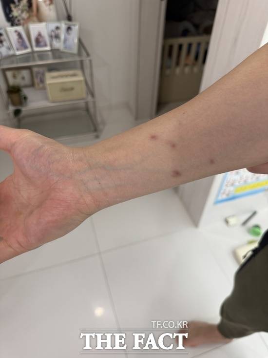 견주 박 싸가 두 달전 '박대송'에게 물린 팔뚝. 아직까지 송곳니 자국이 남아 있다. / 견주 박 씨 제공