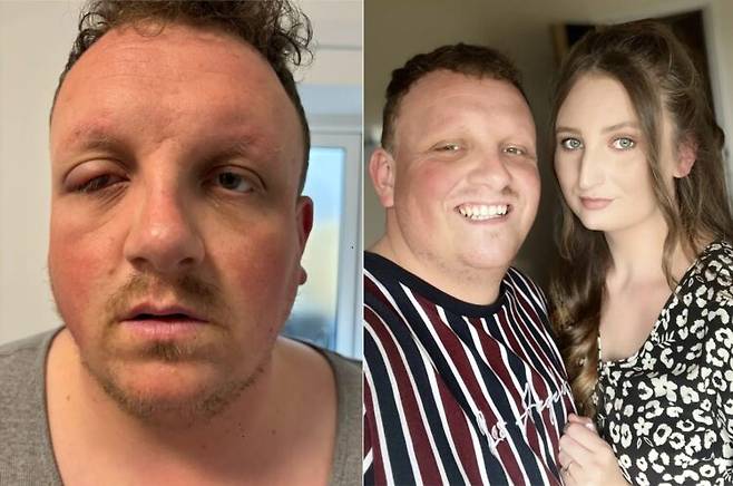 눈이 퉁퉁 붓는 증상을 다래끼로 착각해 시력까지 잃을 뻔한 20대 영국 남성 사연이 공개됐다. [사진=SNS]